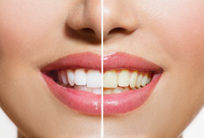 Strahlend weiße Zähne jetzt mit 25 % Rabatt AKTION für Biolase Epic X lasergestützte Zahnaufhellung 